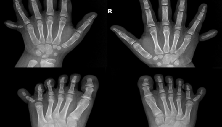 be-gai-co-24-ngon-tay-ngon-chan-do-di-truyen