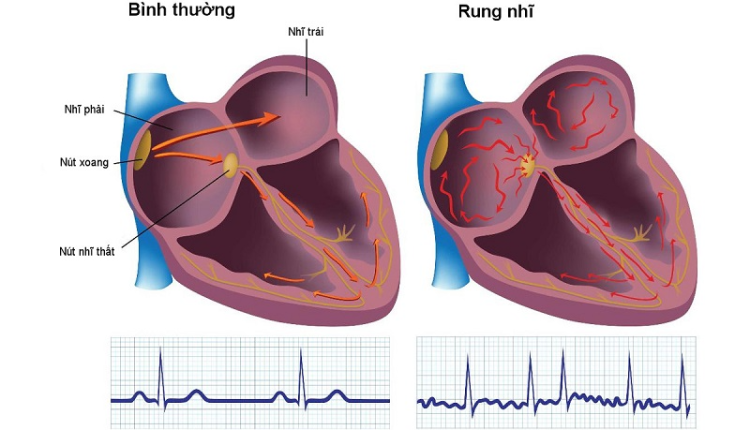 benh-rung-nhi-ngay-cang-tre-hoa
