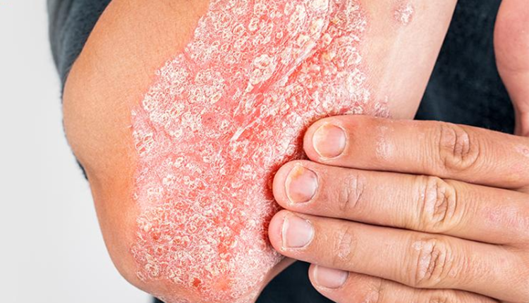 bvdk-tam-anh-tp-hcm-dua-thuoc-sinh-hoc-vao-dieu-tri-vay-nen