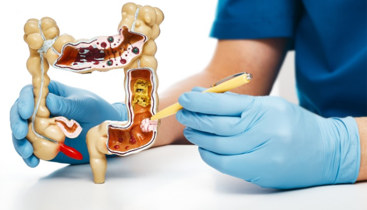 cat-khoi-u-mo-dem-duong-tieu-hoa-nang-25-kg