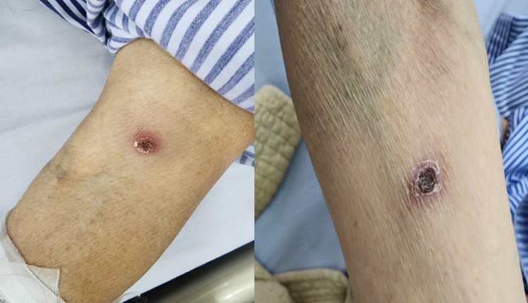 cu-ba-sot-10-ngay-phat-hien-bi-mo-tan-cong