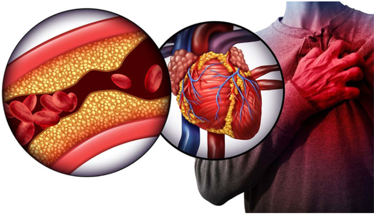 cuu-nguoi-dan-ong-nhoi-mau-co-tim-cap-do-tac-cau-noi-mach-vanh