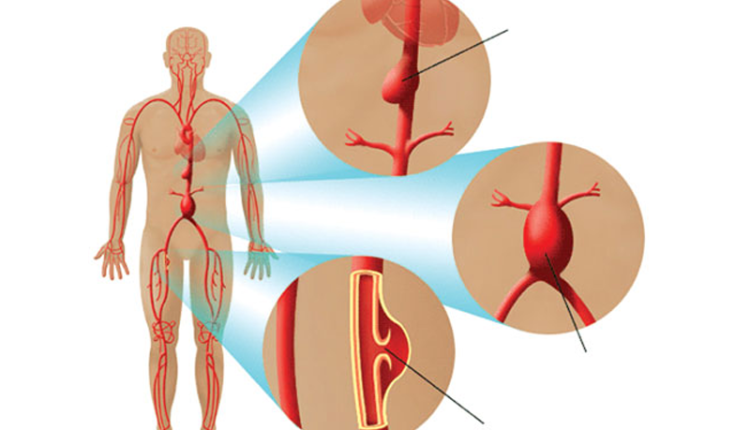 dau-bung-dai-dang-phat-hien-khoi-phinh-mach-mau-sap-vo