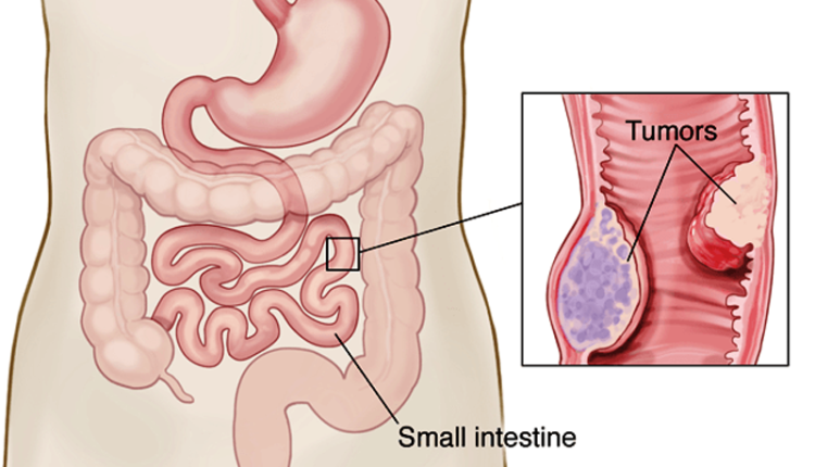 kham-nam-khoa-phat-hien-khoi-u-mac-treo-ruot-non