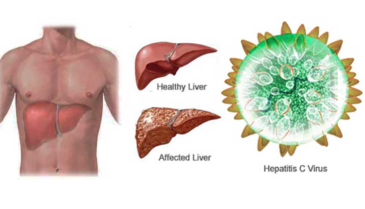 khong-biet-mac-viem-gan-virus-c-du-hien-mau-suot-10-nam