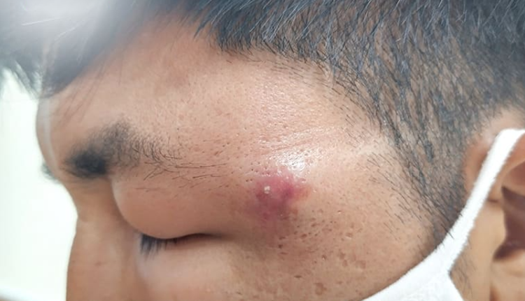 mun-gay-phu-mat-sau-mot-dem