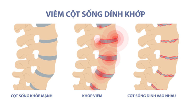 phat-hien-viem-cot-song-dinh-khop-sau-20-nam-chan-doan-nham-benh