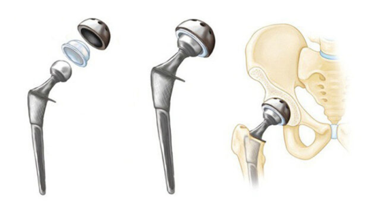 thay-khop-hang-nhan-tao-optimys-cuoc-cach-mang-bao-ton-xuong-va-keo-dai-tuoi-tho