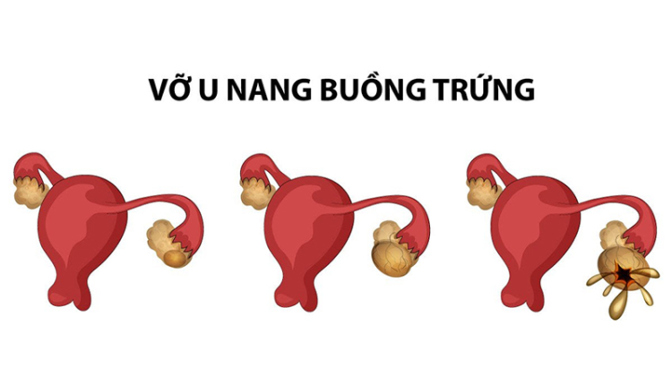 vo-u-buong-trung-to-nhu-thai-9-thang-sau-khi-lac-vong