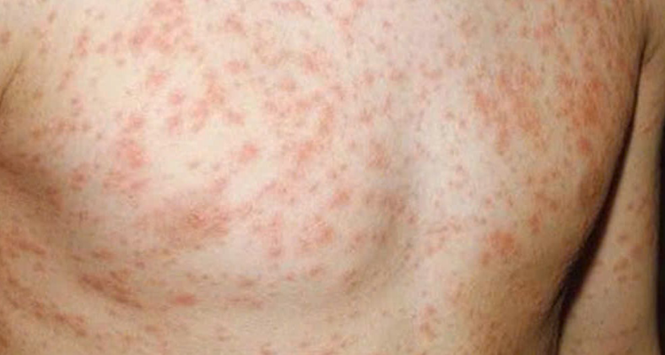 benh-soi-ngay-cang-nhieu-bien-chung-lieu-ban-va-gia-dinh-da-san-sang-doi-pho