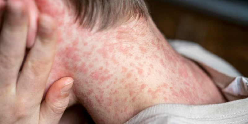 benh-soi-ngay-cang-nhieu-bien-chung-lieu-ban-va-gia-dinh-da-san-sang-doi-pho